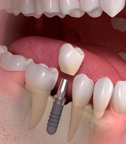 Enkelt Implantat